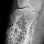 Cáncer de Hueso: Guía Completa de Señales, Diagnóstico y Tratamiento 10 165