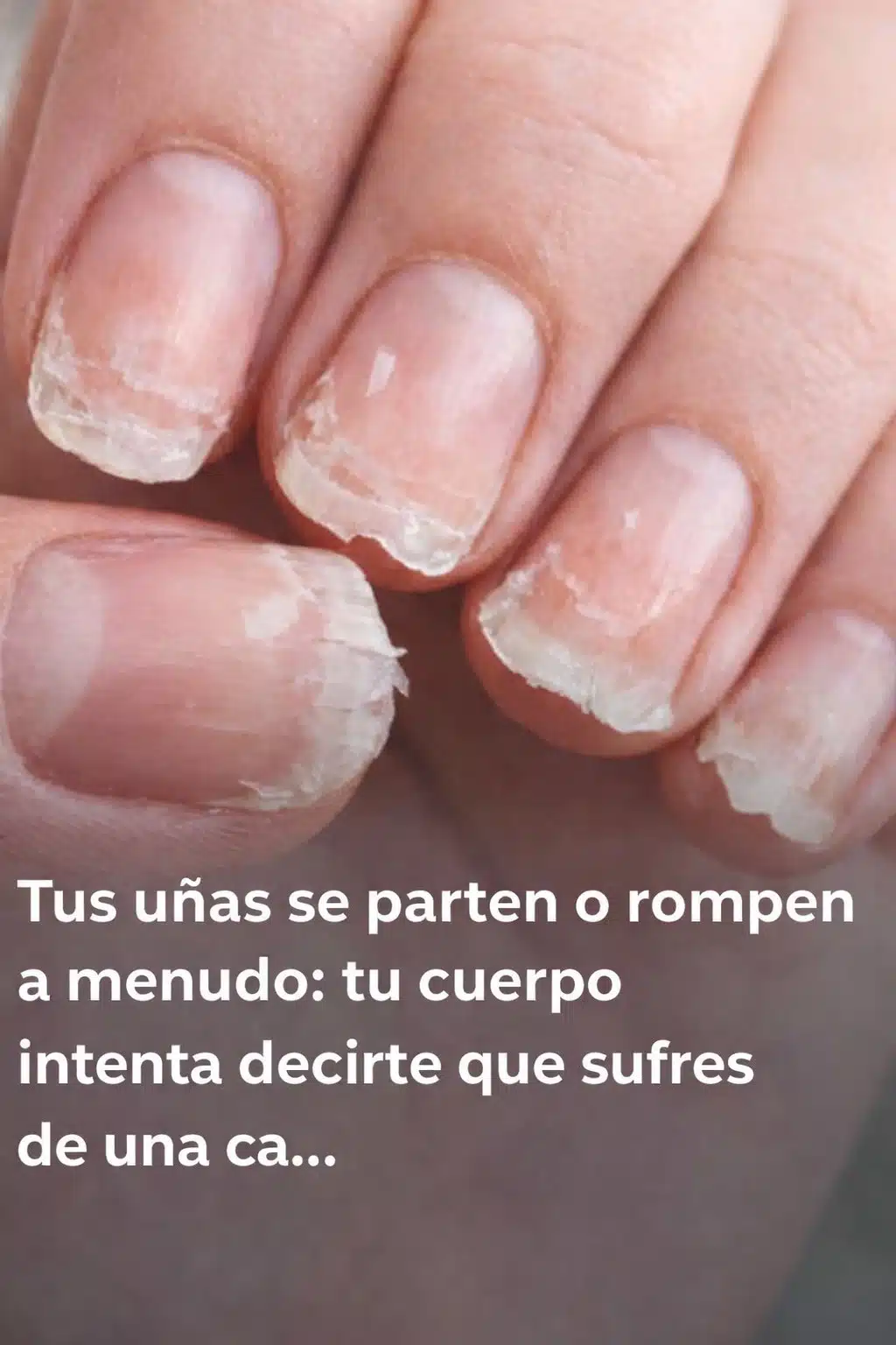 Tus uñas: secretos de salud en tus manos 2 Tus uñas se rompen o se desdoblan: este detalle revela un problema... Ver más