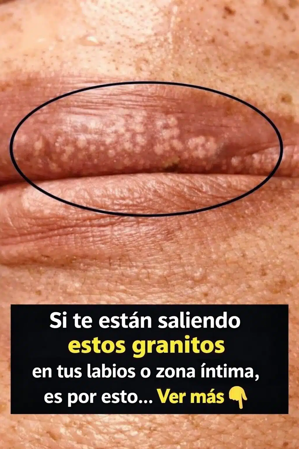Si te salen granitos blancos en los labios o en la zona íntima, puede deberse a…