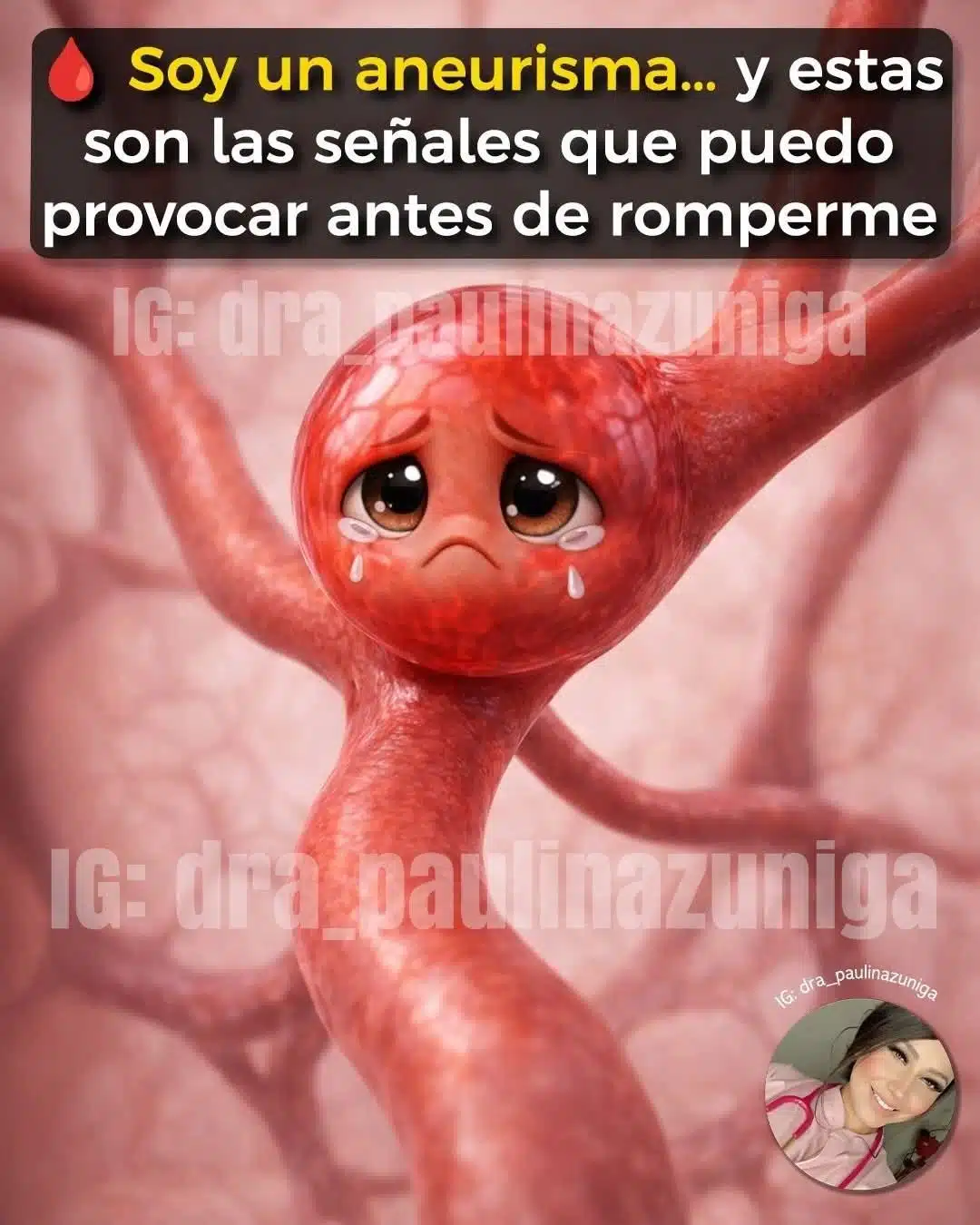 ¿Qué es un Aneurisma? Causas, Síntomas y Cuándo Buscar Ayuda… ver más