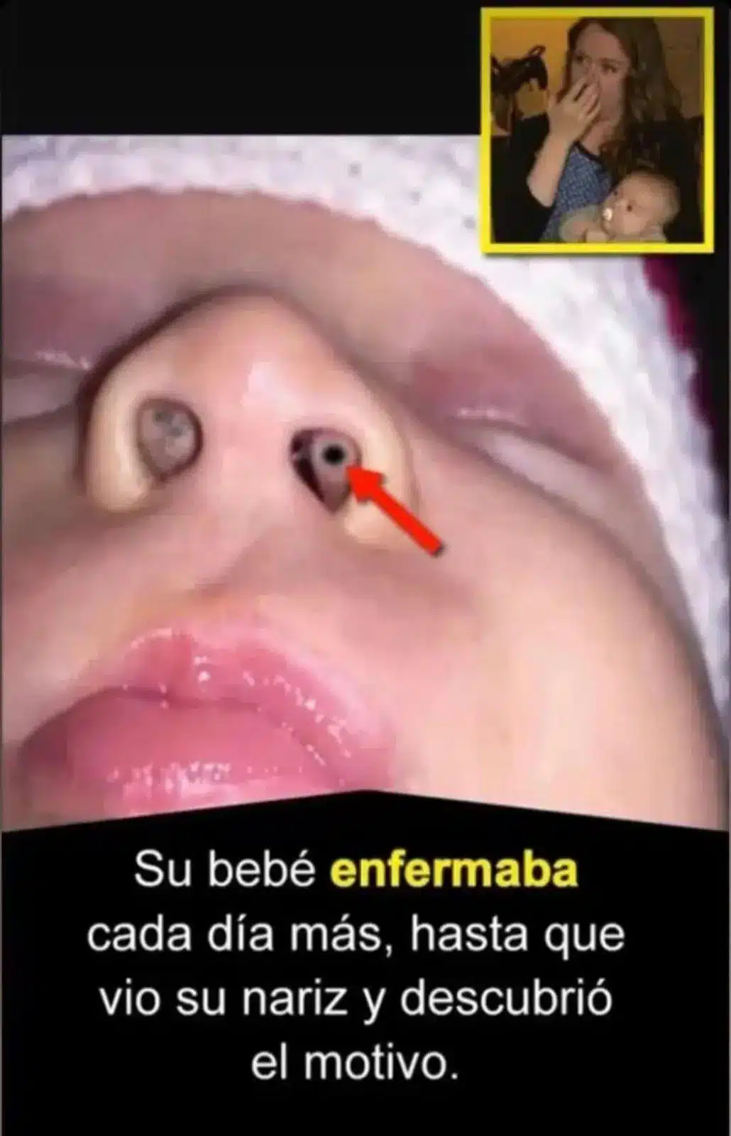 Bebé enfermo descubre causa inesperada en nariz