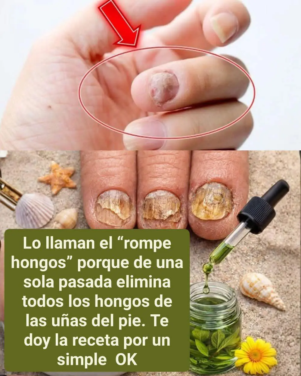 Remedio casero efectivo contra hongos de pies