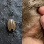 Cómo identificar insectos en la cabeza de niños