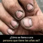 Onicofagia: morderse las uñas causa y consecuencias