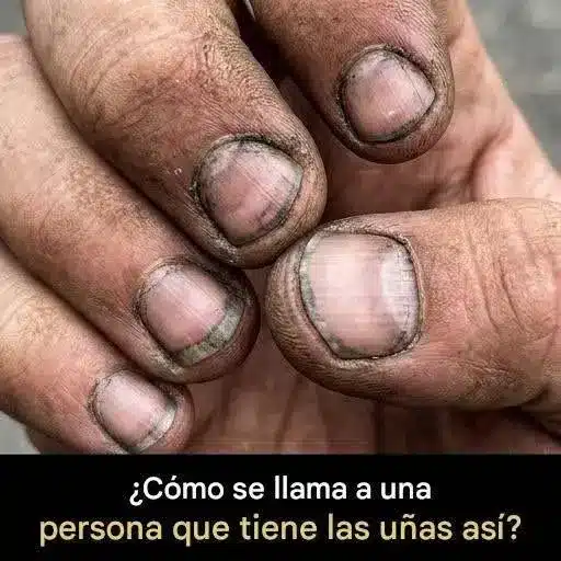 Onicofagia: morderse las uñas causa y consecuencias