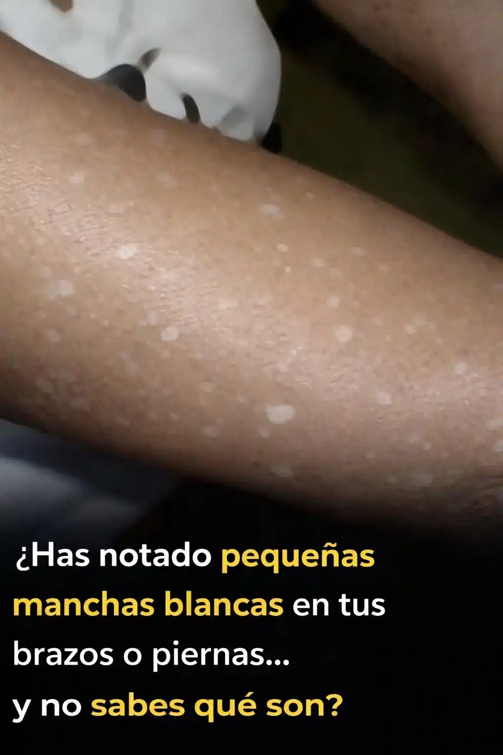 Manchas blancas en brazos y piernas: causas y tratamientos