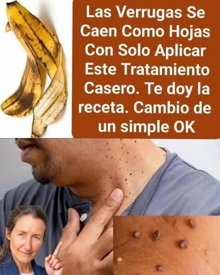 Adiós verrugas: eliminación rápida y segura