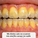 Dientes amarillos: causas y soluciones efectivas