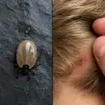Cómo identificar insectos en la cabeza de niños