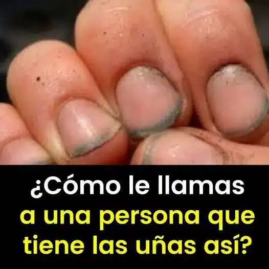 Onicofagia: El significado de morderse las uñas