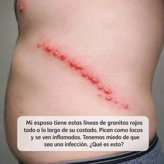 Causas de erupciones cutáneas con picazón intensa