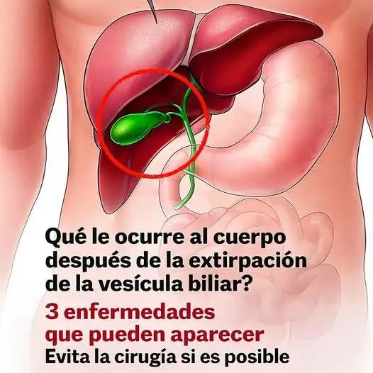 3 condiciones tras la extirpación de vesícula biliar 2 3 condiciones tras la extirpación de vesícula biliar